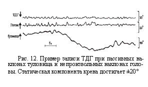 Подпись:  
Рис. 12. Пример записи ТДГ при пассивных на¬клонах туловища и непроизвольных наклонах голо¬вы. Статическая компонента крена достигает ±20°
